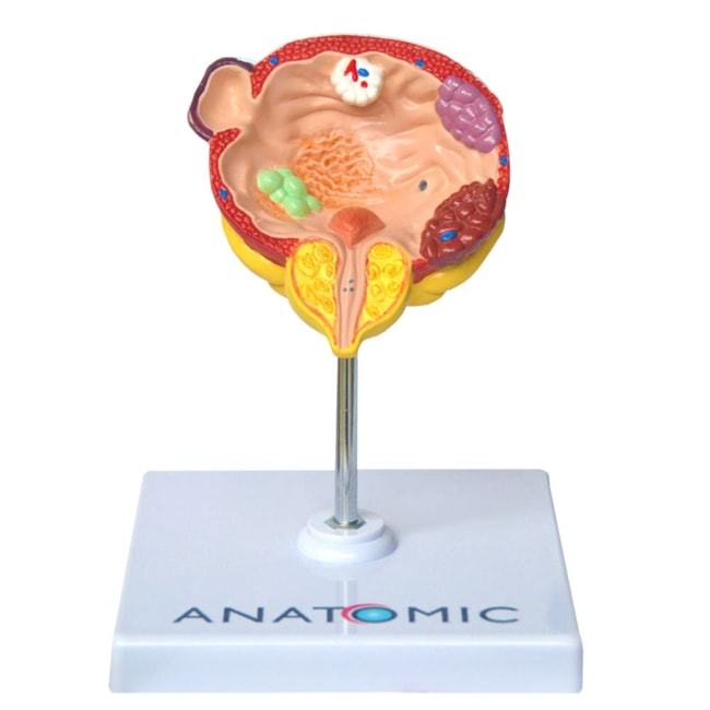 Bexiga Urinária e Próstata com Patologias-e1b5385f-8129-48c7-8913-d122ad412e88