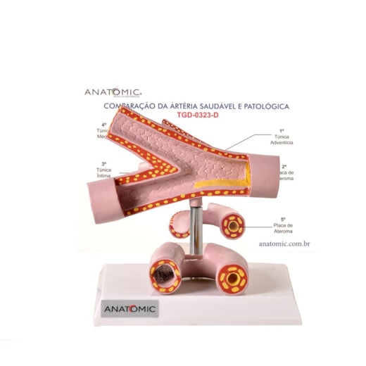 Comparação da Artéria Saudável e Patológica