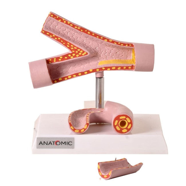Comparação da Artéria Saudável e Patológica-83ba4c73-dea9-4d81-b928-8cda06eaa90d