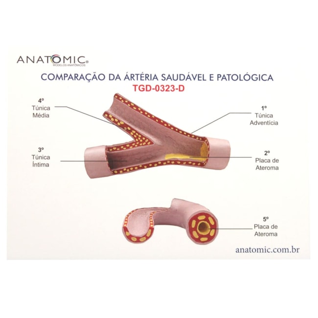 Comparação da Artéria Saudável e Patológica-90ab2b53-9537-44c3-a638-c312d05f0df5