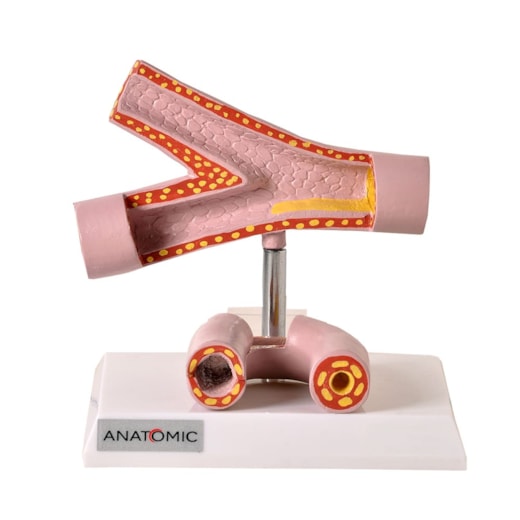 Comparação da Artéria Saudável e Patológica