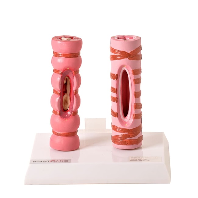 Comparação de Brônquio Saudável e Patológico-6db75d86-aed2-4286-9a38-65c165fad5b2