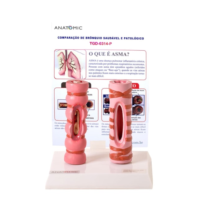 Comparação de Brônquio Saudável e Patológico-1325a678-f61a-46d5-91ac-44e79f4b62d4