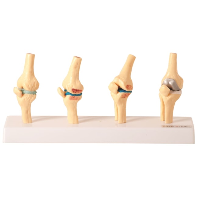 Comparação do Joelho Saudável e Patológico-9fb0b8ee-69ba-4146-8fa5-40e00b137719