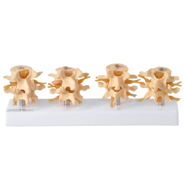 Demonstração de Degeneração das Vértebras em 4 fases-66f7efc7-c5de-4ae9-be39-d1997d814190