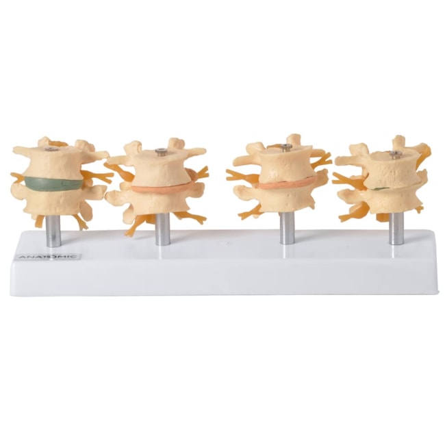 Demonstração de Degeneração das Vértebras em 4 fases-a2b6f83c-72a3-4340-914f-33e526a824b3