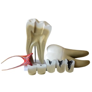 Dente Molar Ampliado com Evolução da Cárie 8 Partes