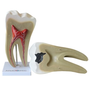 Dente Molar Ampliado Saudável e Cárie