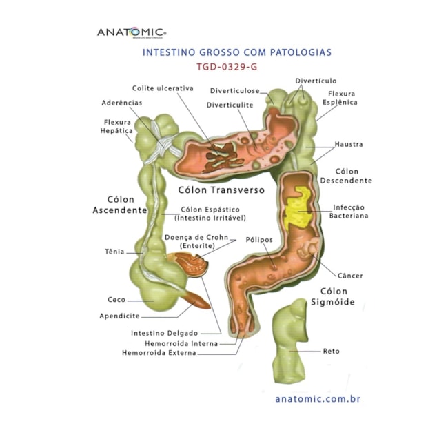 Intestino Grosso com Patologia-e0c04dd1-9476-4046-a376-5af16fc07fe2