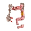 Intestino Grosso com Patologia-e05d9aee-cd76-45eb-b83c-4cbd9de111e7