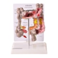 Intestino Grosso com Patologia-a916d451-6d5a-41c5-afef-2b689fd09d26
