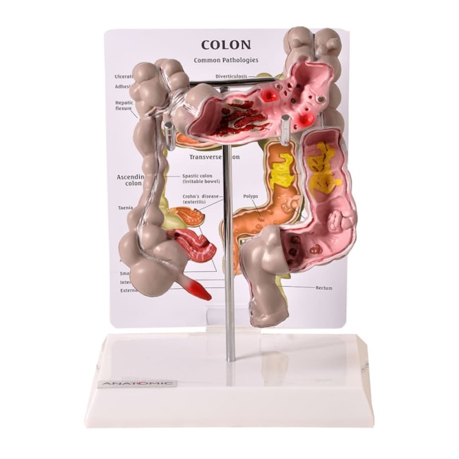 Intestino Grosso com Patologia-6a52c41c-a6d3-4ca2-9a23-74e23c146d65