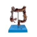 Intestino Grosso com Patologia-7c8f6f5b-38c1-4e39-9274-db1cb64ce9b1