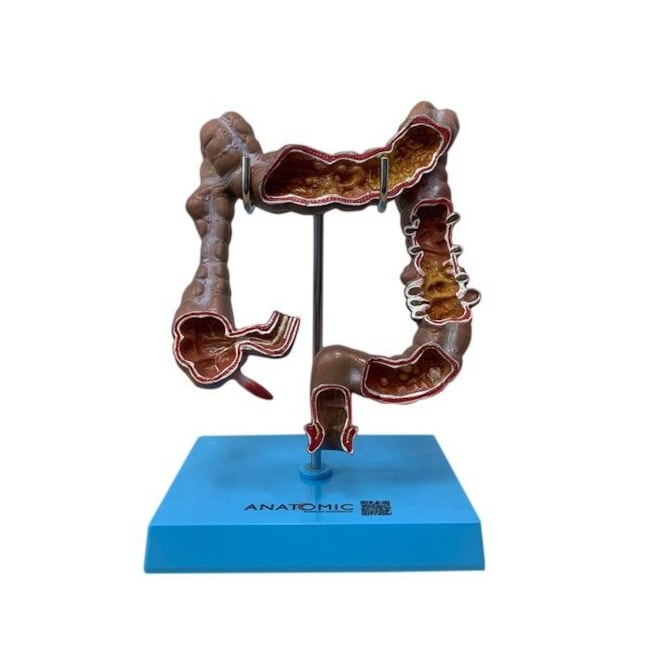 Intestino Grosso com Patologia-fa3450e0-4c78-4f95-bba1-1cbef88a5f63