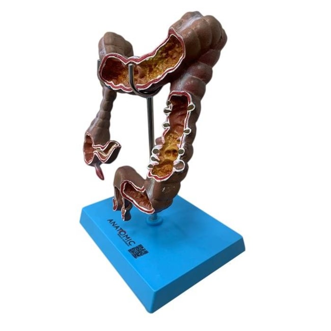Intestino Grosso com Patologia-0e9aae26-fcf1-427d-a92e-37d614483b6d
