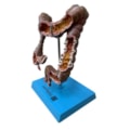 Intestino Grosso com Patologia-5dba4fd0-3181-420c-94c9-5a7773e3ee77