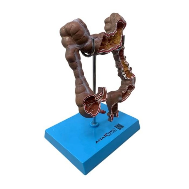 Intestino Grosso com Patologia-a680a6fd-c035-4660-9c40-19c73f9b493c