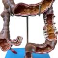 Intestino Grosso com Patologia-889ca123-5ff8-4492-99d5-f61a861a5891