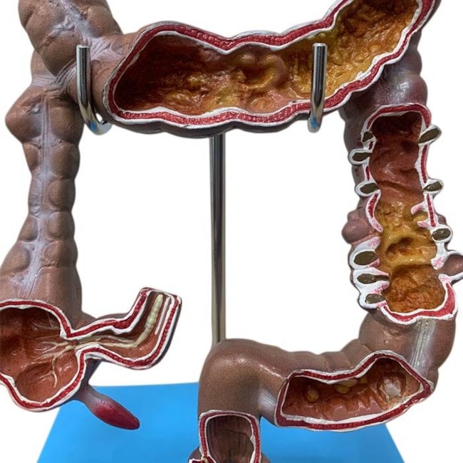 Intestino Grosso com Patologia-4d462d06-9dcb-4da0-964f-6fc171f92fda