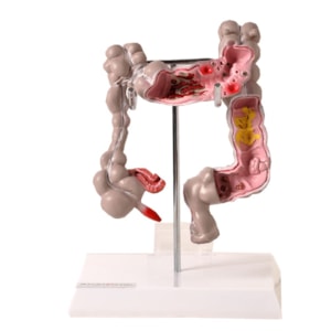 Intestino Grosso com Patologia