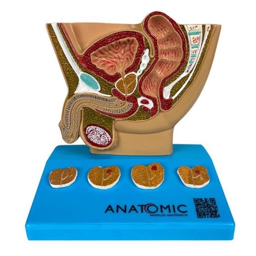 Modelo Anatômico da Pelve Masculina com Patologias de Próstata