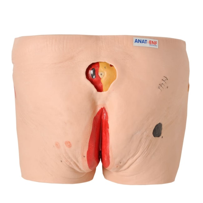 Modelo de Úlcera por Pressão-13b6510f-9438-44e6-ac24-42e7551ca1c5