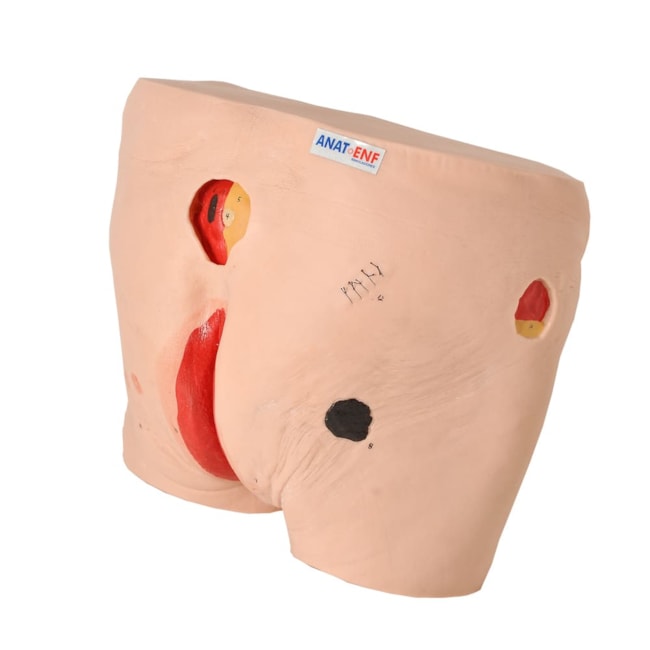 Modelo de Úlcera por Pressão-ba47e52f-3722-4c1c-83a9-2eb65a3984e0