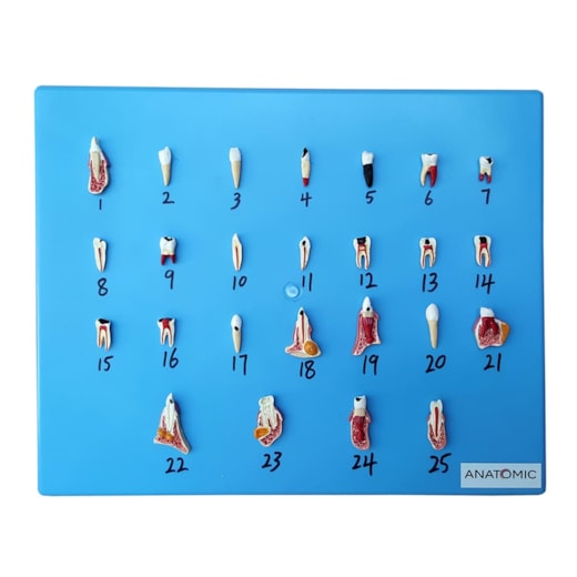 Patologia Dentária 25 Peças