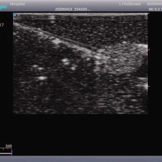 Simulador de Mamas para Exame Clínico e Ultrassonografia Mamária