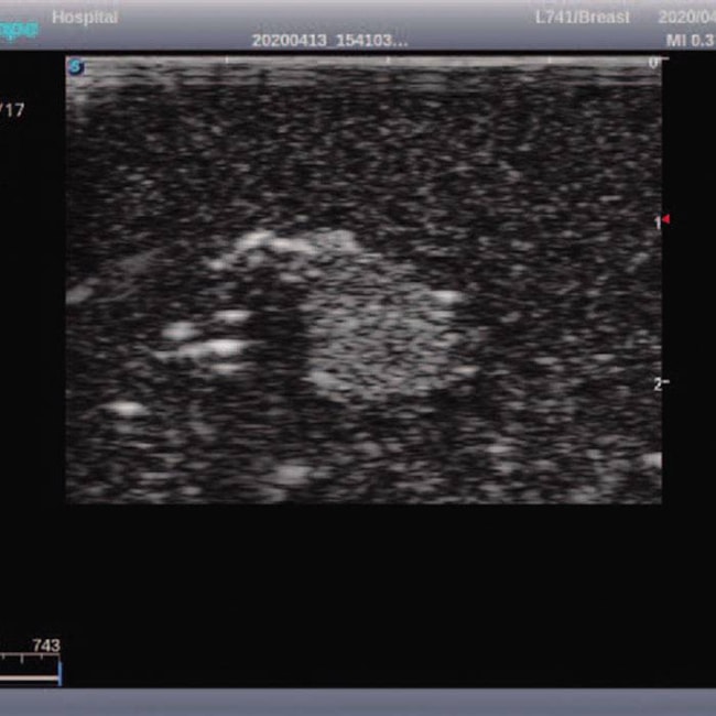 Simulador de Mamas para Exame Clínico e Ultrassonografia Mamária-64c1fd87-c908-40d0-8984-0f2f9c0ed871