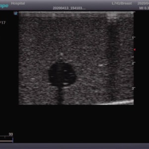 Simulador de Mamas Vestíveis para Exames e Ultrassonografia Mamária