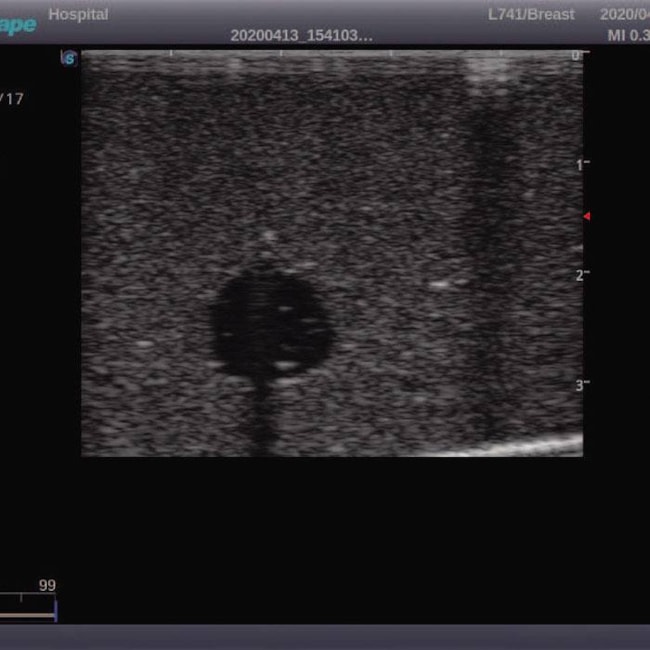 Simulador de Mamas Vestíveis para Exames e Ultrassonografia Mamária-c002bc50-69ca-4d12-b1b9-bed62ac01c0e