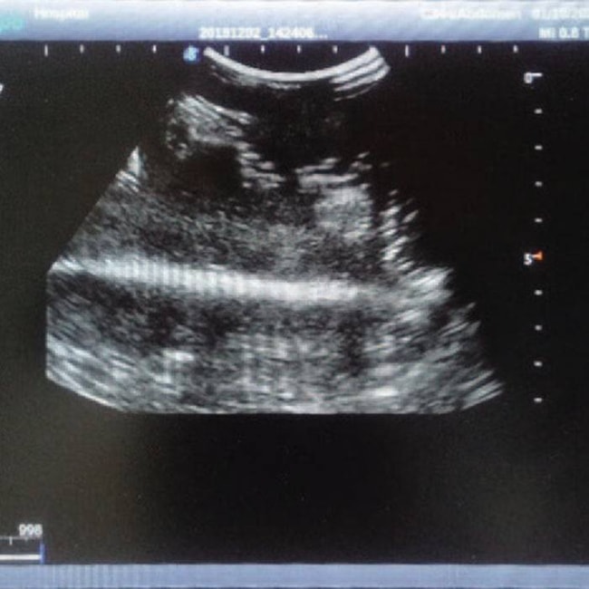 Simulador de Mamas Vestíveis para Exames e Ultrassonografia Mamária-b17eeebb-425d-44ff-8696-4691a462e03f