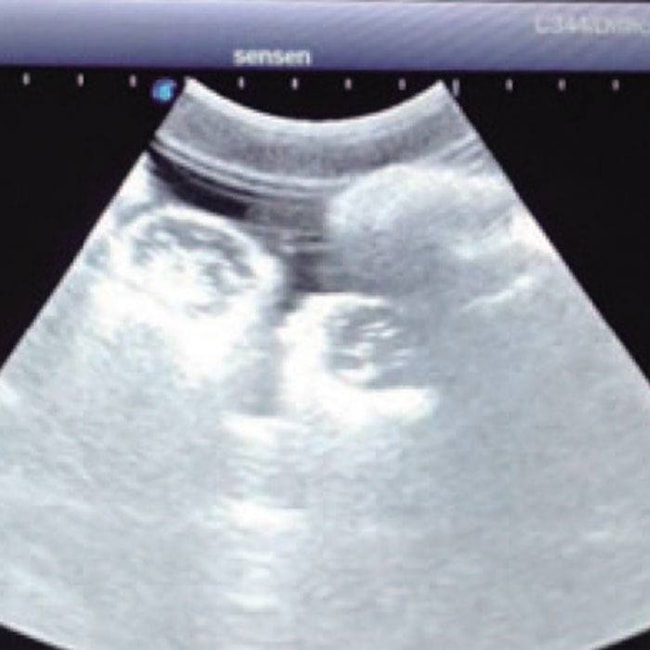 Simulador para Punção Arteriovenosa Femoral e Abdominocentese Guiada por Ultrassom-fbe63aad-95bf-4e6a-906c-77fb45c2779a