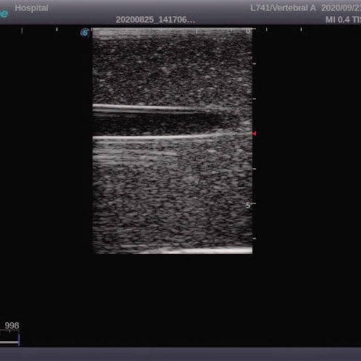 Simulador para Treinamento de Acesso Vascular Guiado por Ultrassom