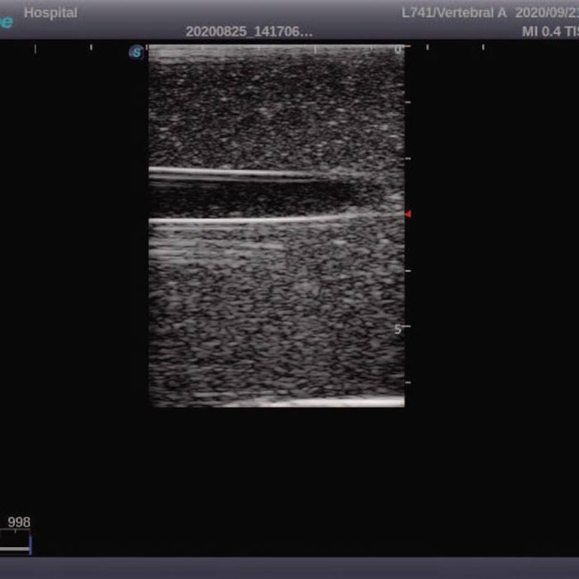 Simulador para Treinamento de Acesso Vascular Guiado por Ultrassom-b3294dd9-ea3d-4f48-a9c0-0838e6b14fb0