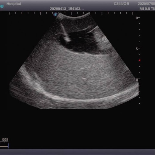 Simulador para Treinamento de Amniocentese Guiada por Ultrassom