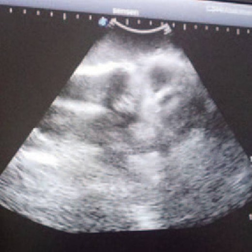 Simulador para Treinamento de Artrocentese de Joelho Guiada por Ultrassom