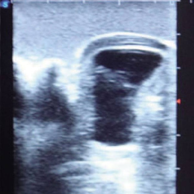 Simulador para Treinamento de Artrocentese de Joelho Guiada por Ultrassom-3fe6f319-7d2e-470c-be62-563aa1e9bba1