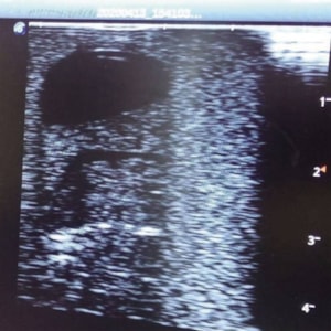 Simulador para Treinamento de Drenagem de Abscessos Guiada por Ultrassom