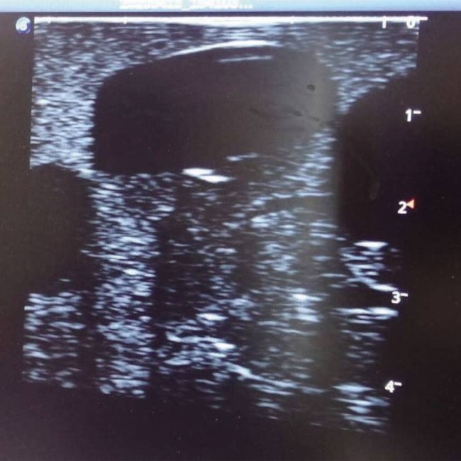 Simulador para Treinamento de Drenagem de Abscessos Guiada por Ultrassom-46c9afc2-2785-4266-b967-4971001aeb05