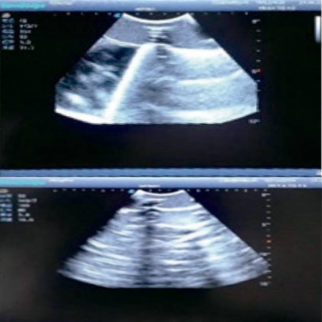 Simulador para Treinamento de Pneumotórax e Drenagem Torácica Guiada por Ultrassom-3bafeb12-0cc1-4330-a558-bde1c71d34fc