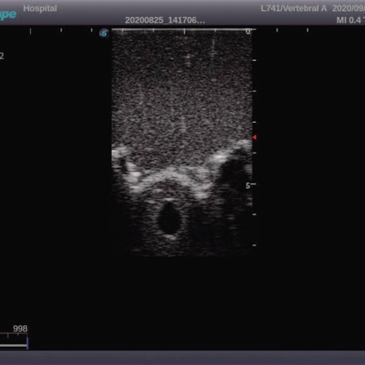 Simulador para Treinamento de Punção Lombar Adulto Guiada por Ultrassom