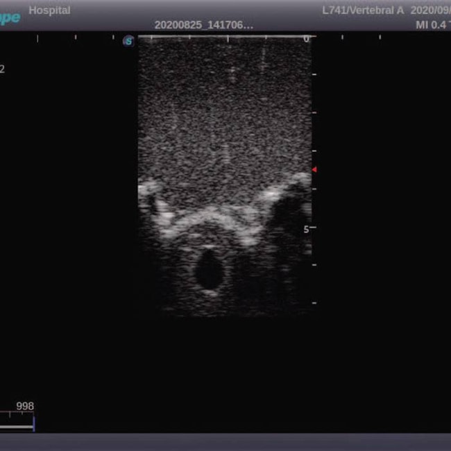 Simulador para Treinamento de Punção Lombar Adulto Guiada por Ultrassom-4eb08669-5d2a-4706-ae56-746df5a68c46