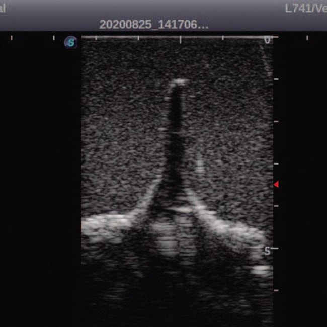 Simulador para Treinamento de Punção Lombar Adulto Guiada por Ultrassom-d4b8b8f2-4290-41ea-8cbd-e11c3195d4d0