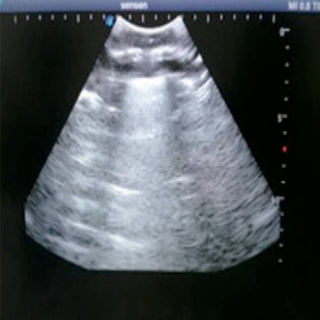 Simulador para Treinamento de Toracocentese Guiada por Ultrassom-4c17acf0-36a1-4081-82c7-7855cf34276c