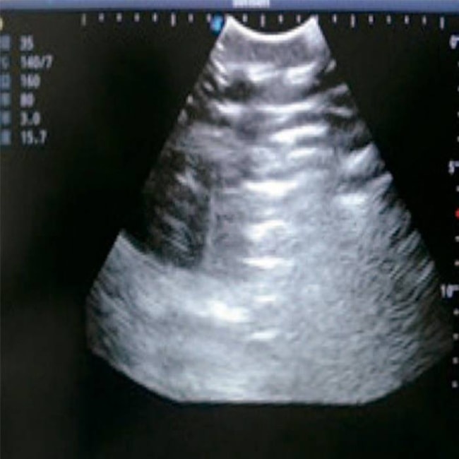 Simulador para Treinamento de Toracocentese Guiada por Ultrassom-a96e25ff-bcf5-4a61-9fd6-b3a264d62c15