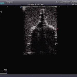 Simulador Pediátrico para Treinamento de Punção Lombar Guiada por Ultrassom