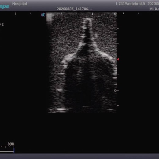 Simulador Pediátrico para Treinamento de Punção Lombar Guiada por Ultrassom