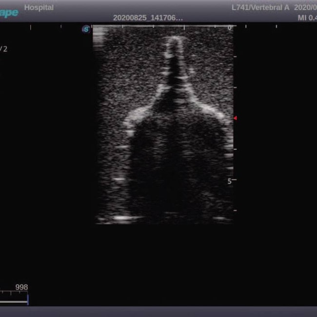 Simulador Pediátrico para Treinamento de Punção Lombar Guiada por Ultrassom-196870d5-9bf5-4f07-9f78-84af993ae4cf